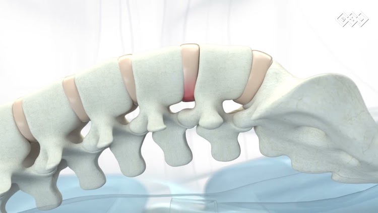 soluciones-personalizadas-columna-tecnica-descompresion-vertebral-2