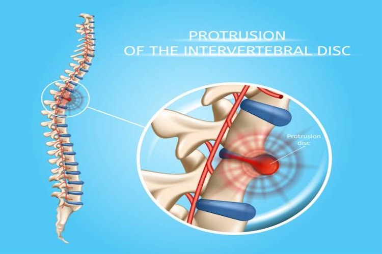 Protrusion of Intervertebral Disc Realistic Vector Medical Poster with Magnification of Damaged, Painful Spine Disc. Human Musculoskeletal System Problems with Disease Symptoms Explaining Illustration